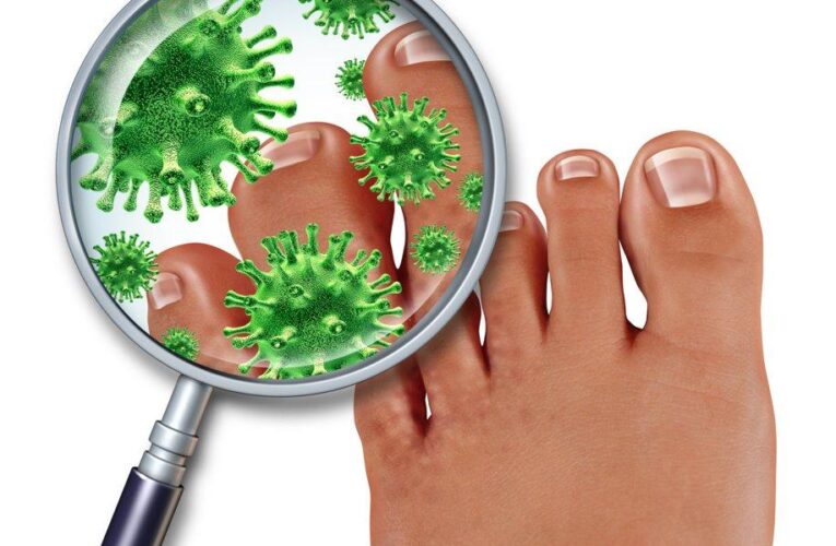 What is the best treatment for tinea pedis?