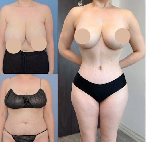 Tummy Tuck Surgery and Body Positivity