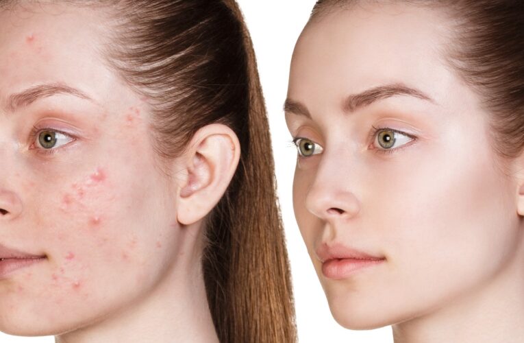 Best Acne Treatment Vienna – Comprehensive Skincare