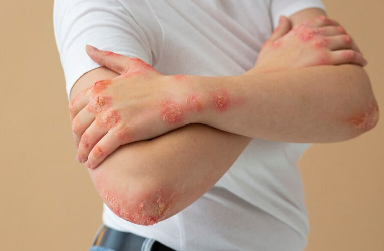 Fungal Skin Infections: Symptoms, Types, and Treatment