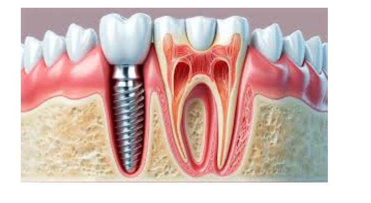 Evolution of Dental Implants: A Modern Solution to Missing Teeth