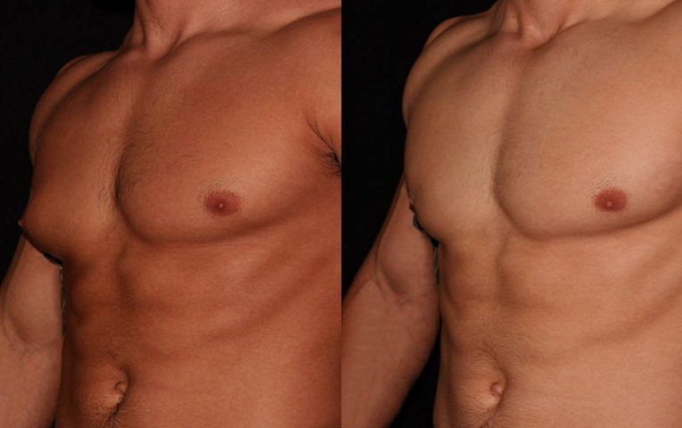 Long-Term Effects and Benefits of Gynecomastia Surgery